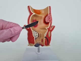 Doctor is holding scalpel anatomy of rectum problem