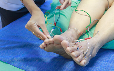 Chinese Acupuncture with Electrical stimulator on feet - obrazy, fototapety, plakaty