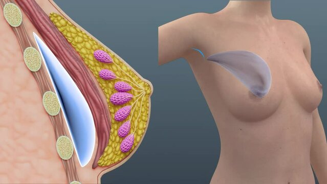Breast Implants, Silicone breast implants, Axillary Skin Incision, 