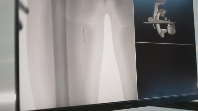 Thrombectomy, mri scan screen. Surgeons perform an operation to remove a blood clot in a vessel in the leg. Innovative technologies for the treatment of thrombosis. X-ray scan of blood vessels.