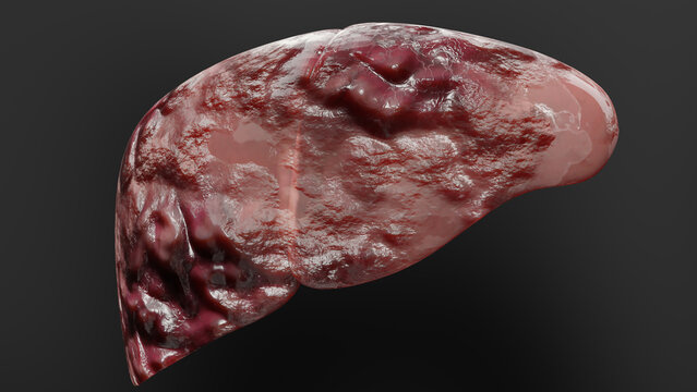 Digestive Organ Liver Cancer, Hepatitis cirrhosis malignant tumor, Hepatic failure, growing cells, duplicating, Fibrosis, Cirrhosis, Hepatocellular carcinoma, Virus infected liver, Human, 3d render