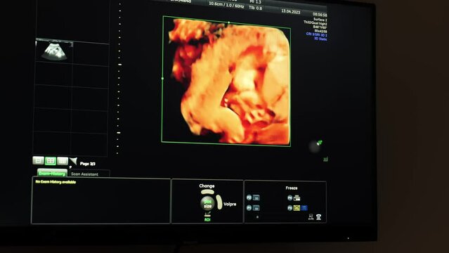 Ultrasound of a baby in the womb close-up