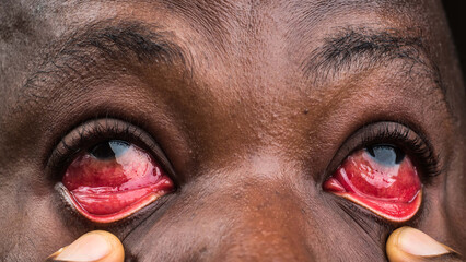 Eyes section of a face showing infectious, unhealthy, and abnormal redness of the eye which is...