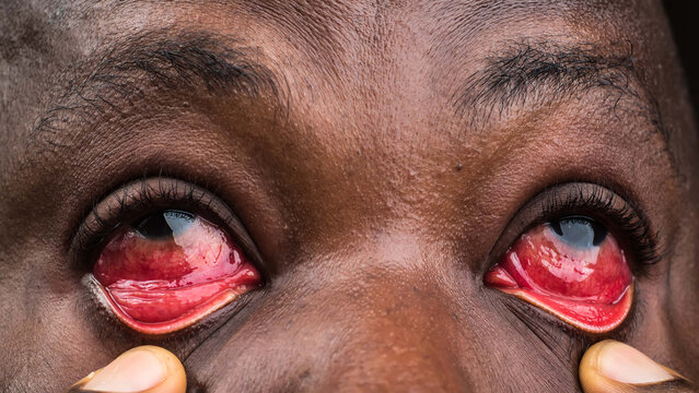 Eyes section of a face showing infectious, unhealthy, and abnormal redness of the eye which is caused by a communicable disease called conjunctivitis health condition, also known as Apollo in Nigeria,