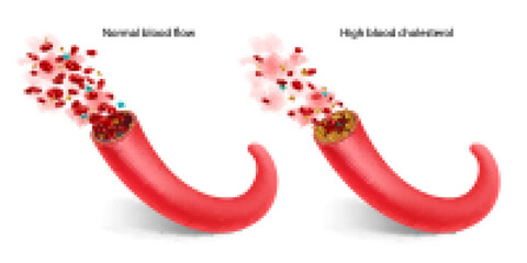 High cholesterol. Isolated vector illustration