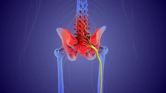 The medical concept of sciatic nerve pain