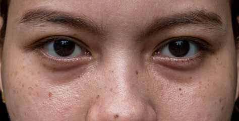 Black spots, moles and scars around the eyes of Asian woman.