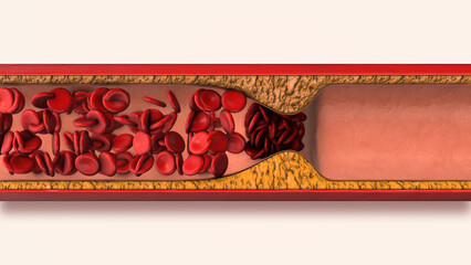 Severe atherosclerosis coronary artery disease