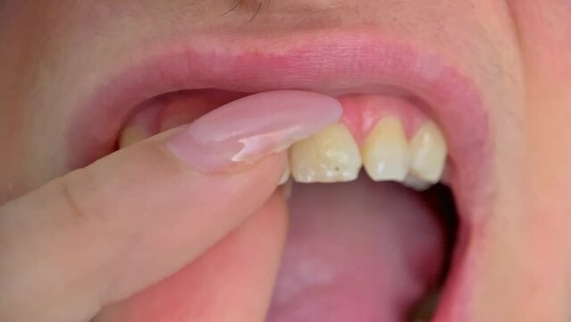 woman putting on removable dentures