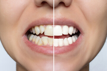Young woman's smile before and after teeth straightening. Ideal, beautiful shape of teeth on the...