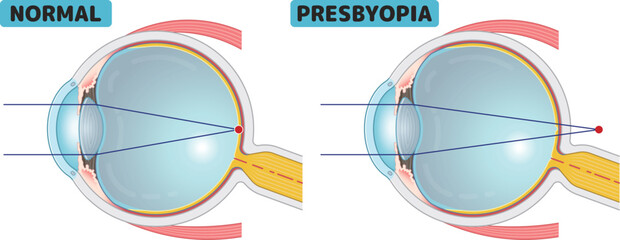 近視、遠視、老眼、乱視、myopia、hyperopia、presbyopia、astigmatism・eye・illustration - obrazy, fototapety, plakaty