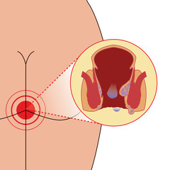 Emorrhoids on anal blood focus thrombosis, illustration on white background - obrazy, fototapety, plakaty