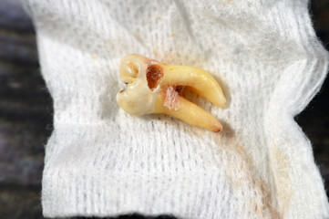 Extracted wisdom 8th lower right tooth with a teeth decay, after exposed nerve and severe pain,...
