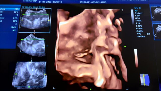Footage Ultrasonography of 28 weeks pregnancy.