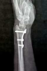 Plain x ray showing a recent fissure fracture at the lower part of a left radius bone, also showing...