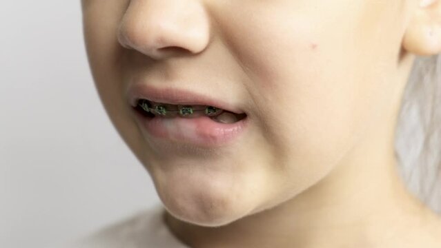Close-up, a child girl bites her lower lip with teeth with braces.