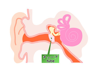 鼓膜にチューブが刺さっている状態のシンプルなイラスト