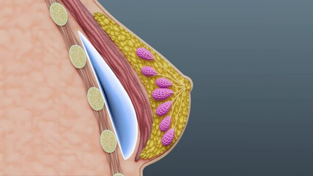 Breast Implants, Silicone breast implants, Axillary Skin Incision,
