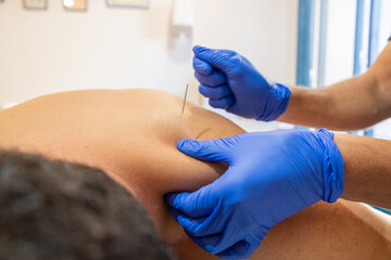  A hand is gently applying acupuncture to a person’s back.