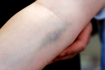 Vein and several injection marks. Partially healed wounds after treatment for illness or infection with a virus.
