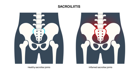 Sacroiliitis medical poster