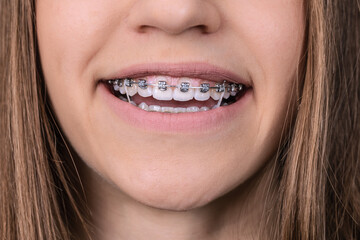  Girl teeth  with braces and elastic rubber. Orthodontist treatment.