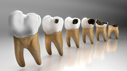 Human Tooth Decay A 3D Dental Caries Progression 3d Model