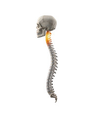 Human spine with lumbar with pain in cervical region