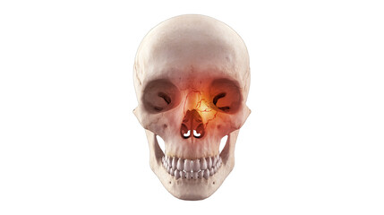 Cranial nose fracture on human skull