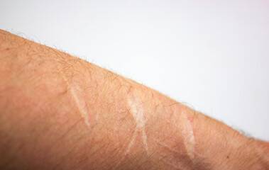 Scars from cuts on the arm. Old traces of a skin cut on the forearm.