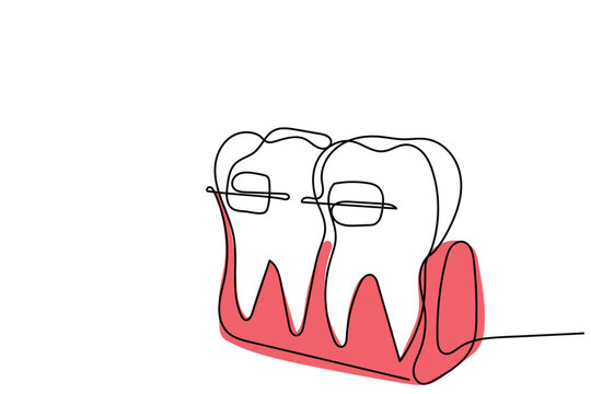  line art of Orthodontic treatment. Dentists day and respect for their services to humanity. Dental procedures vector art concept. Isolated vector of teeth and jaws. Retainers braces denture