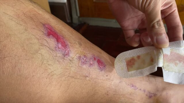 Close up male hand peeling sticky clean hygienic cotton antiseptic from fresh wound on man's leg shin indoor at home after accident. Medical treatment concept