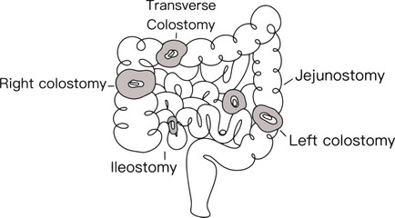 Intestines. Stoma. Medicine. One line