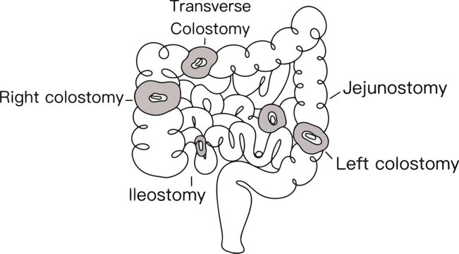Intestines. Stoma. Medicine. One line