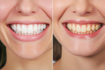 dental transformation showcasing the process of whitening teeth. In the before image, a woman's teeth appear yellow and in the after image, her teeth are noticeably whiter - obrazy, fototapety, plakaty