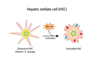 Hepatic stellate cell, HSC. Quiescent HSC vitamin A storage. Activated HSC, collagen deposition. Liver fibrosis. vector illustration. - obrazy, fototapety, plakaty