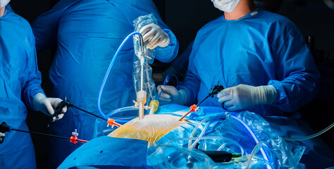 A team of surgeons in a dark operating room under the light of surgical lamps performs an operation to remove a cancerous tumor in a patient's intestine. Minimally invasive laparoscopic surgery.