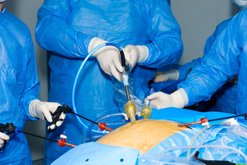 Doctors remove a cancerous tumor in a patient's intestine using laparoscopic surgical manipulators....
