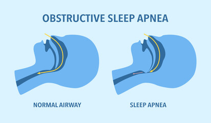 Obstructive sleep apnea concept. Sleep disorder. - obrazy, fototapety, plakaty