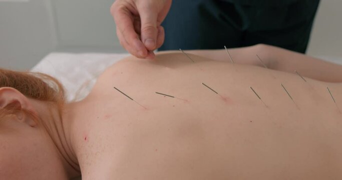 male therapist doctor taking out acupuncture needles off the woman's back in a spa center Acupuncture therapy Slow motion, guy removing the needle from the skin.
