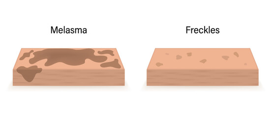 The difference between skin with melasma and skin with freckles. Human skin layer anatomy vector.
