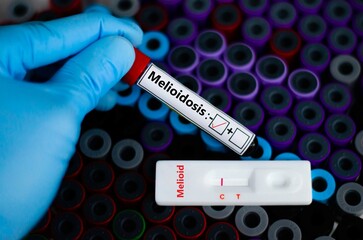 Fototapeta premium The patient negative for melioidosis by rapid diagnostic test.