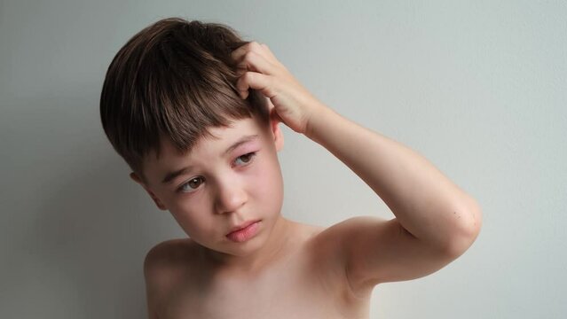 The boy looking at the camera rubbing and scratching head with a swollen eye from an insect bite. Close-up view. Angioedema. Allergic response. Red inflamed upper eyelid. Inflammation. Itching bites