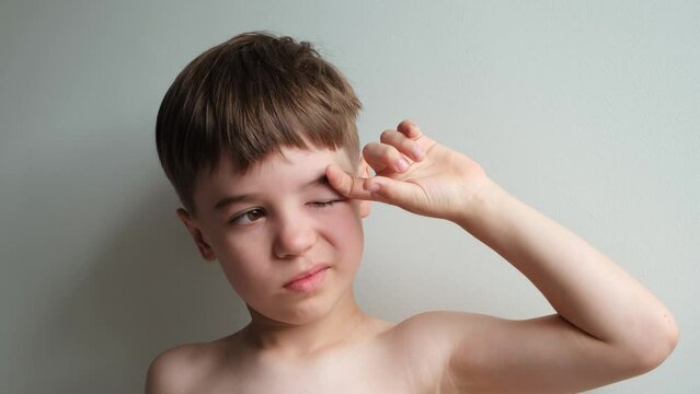 The boy looking at the camera rubbing his swollen eye from an insect bite. Close-up portrait. Angioedema. Allergic response. Red inflamed upper eyelid. Inflammation. Itching bites. The tired child