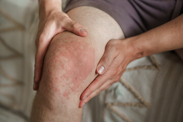 Rash or eczema on a man's knee, allergic reaction with red spots - obrazy, fototapety, plakaty