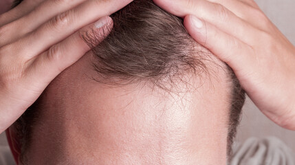 Middle aged man showing receding hairline on his head, androgenetic alopecia concept, baldness,...