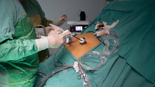 Obesity surgery. Weight loss surgery is performed with laparoscopic surgery. Operating room doctor and team performing surgery
