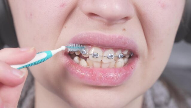 Teenager brushing metal brackets by orthodontic toothbrushes, dental floss. Dental care hygiene concept with braces. Cleaning braces teeth system, close-up. Oral care concept with braces.