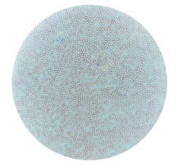 Microscopic view of  Abnormal red blood cells from thalassemia patient.