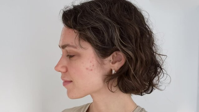 Portrait of attractive young woman  30s with problematic skin. Acne in adulthood. Face beautiful woman before laser treatment, derma pen. Skin with severe inflammation, rash, irritation, scarring. UGC
